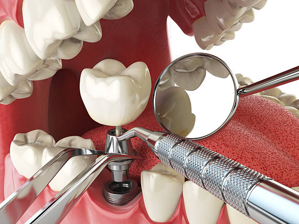 Best Emergency Tooth Extraction in Delphi, IN